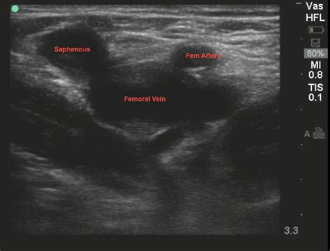 Vascular Ultrasound Of Legs