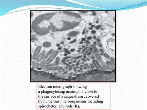 Necrotizing periodontal diseases by Dr Rinky Tripathi pg 2nd year ...