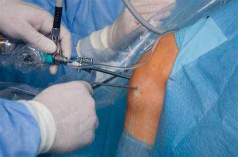 Nerve Block For Knee Arthroscopy