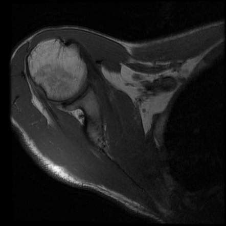 Bony Bankart Injury With Hill Sachs Image Radiopaedia Org