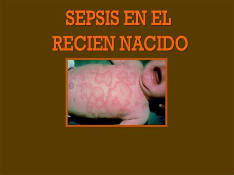 SEPSIS NEONATAL OrosMed UDocz