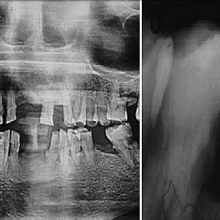 Radiographs Opg And Iopa Showing A Well Defi Ned Mixed Radiolucent