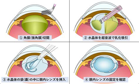 黄斑下出血の原因と手術治療｜茨城県水戸市の小沢眼科内科病院