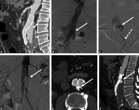 Embolization Of Type Ia Endoleak With Inferior Mesenteric Artery Ima