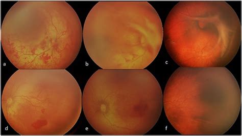 Efficacy Of Ultra Low Dose 0 1 Mg Ranibizumab Intravitreal Injection For Treatment Of