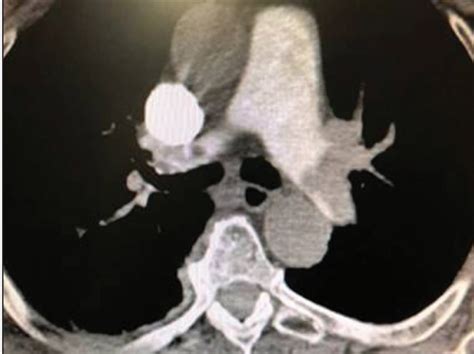 Endovascular Today - Improving the Risk/Benefit Profile for Managing ...