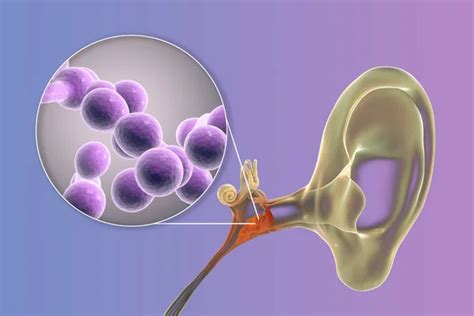 Otitis Media Supurativa Crónica Causada Por Hongos Candida Enfermedad