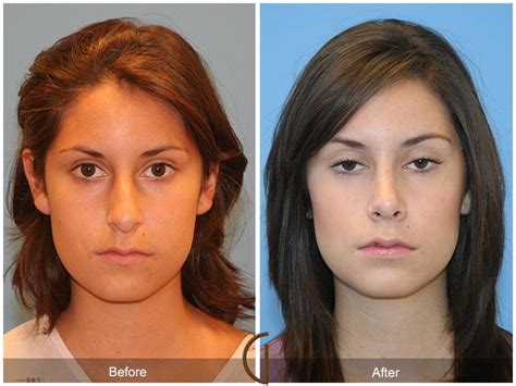 Ethnic Rhinoplasty Before And After Photos Patient 07 Dr Kevin Sadati