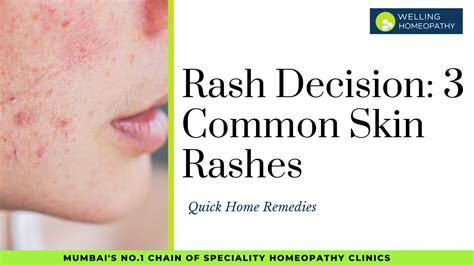 Rash Decision: 3 Common Skin Rashes And Quick Home Remedies