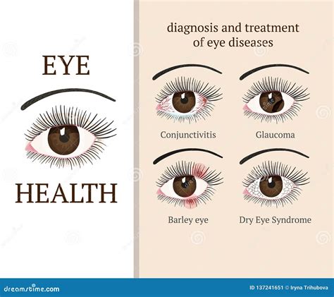 Types Of Conjunctivitis Cartoon Vector | CartoonDealer.com #94545137