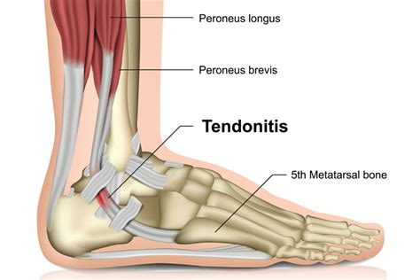 6 Effective Exercises to Treat Peroneal Tendonitis – Cincinnati Foot ...