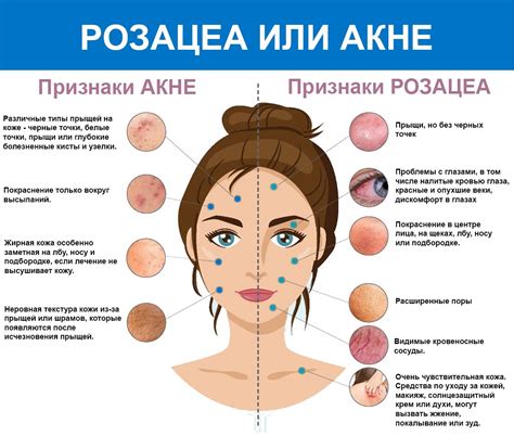 Лікування розацеа ≡ Блог MED CITY | Діагностика та лікування розацеа у ...