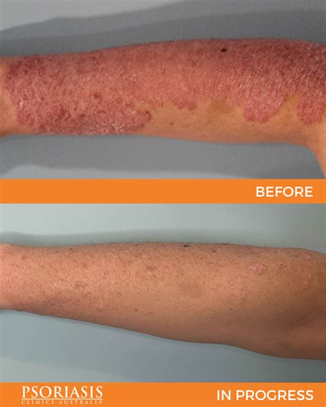 Psoriasis Specialist Gallery Psoriasis Clinics Australia