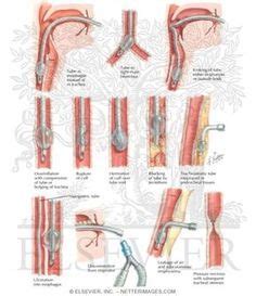 Endotracheal intubation