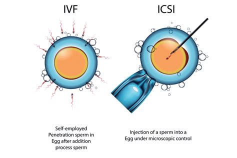 Ivf Vs Icsi Difference Between Ivf And Icsi