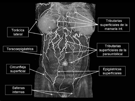 Figure From Circulaci N Colateral De Pared Abdominal Anatom A