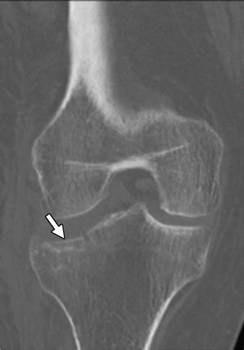 Three Column Classification System For Tibial Plateau Fractures What The Orthopedic Surgeon