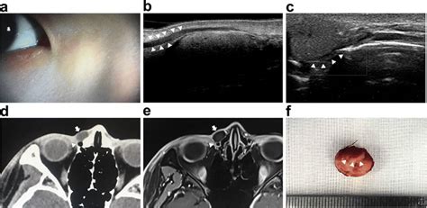 Epidermoid Cyst Adjacent To The Lacrimal Sac A 21 Year Old Male