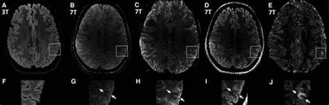 7t Mri In Focal Epilepsy With Unrevealing Conventional Field Strength Imaging De Ciantis