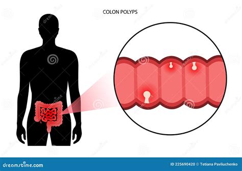 Colon polyps inflammation stock vector. Illustration of body - 225690420