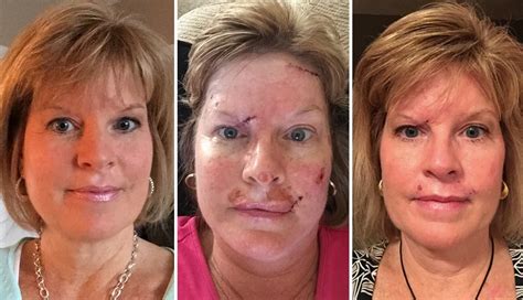 Show Pictures Of Skin Cancer On The Face Cancerwalls