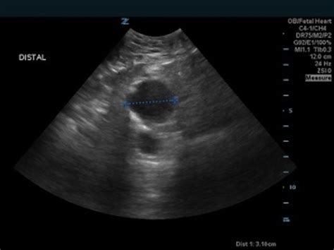 Iliac Artery Aneurysm, Aorta Ultrasound 3 Annotated. JETem 2020 - JETem