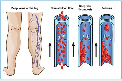 What Is Deep Vein Thrombosis