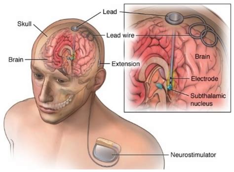 Electronics Free Full Text Low Noise Amplifier For Deep Brain Stimulation Dbs