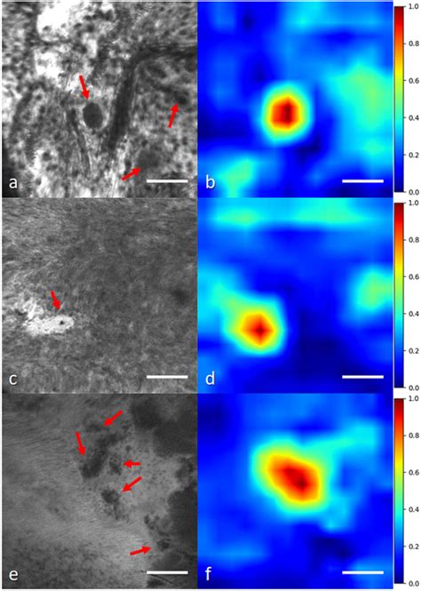 Histological Glioma Feature Localization With A Weakly Supervised