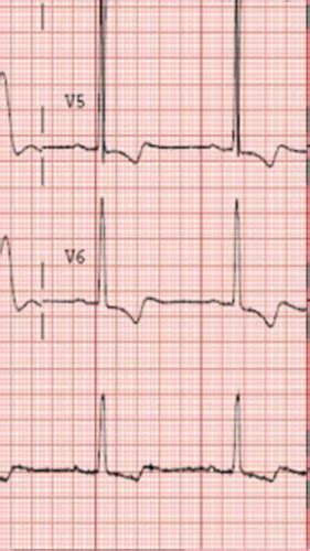 Ventricular Hypertrophy And Atrial Enlargement On Ecg Flashcards Quizlet