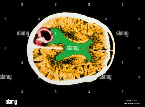 Axial Computed Tomography Ct Scan Of A Childs Brain Showing