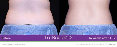 Trusculpt Id Nyc Body Sculpting The Dermatology And Laser Group