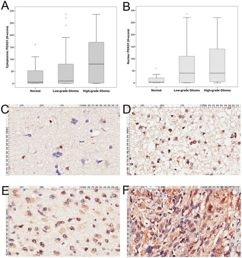 Tissue Microarray Analysis Of FOXO1 Expression A B Cytoplasmic And