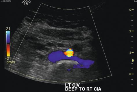 Pelvic Congestion Syndrome Thoracic Key