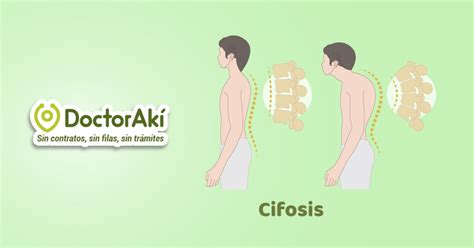 Cifosis Conoce Las Causas Síntomas Y Tratamientos Doctorakí