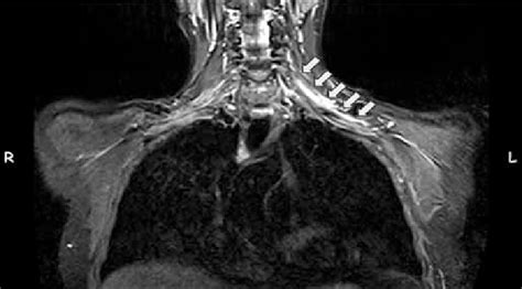 Brachial Plexus Mri Contrast Media Enhancement Was Shown At Left