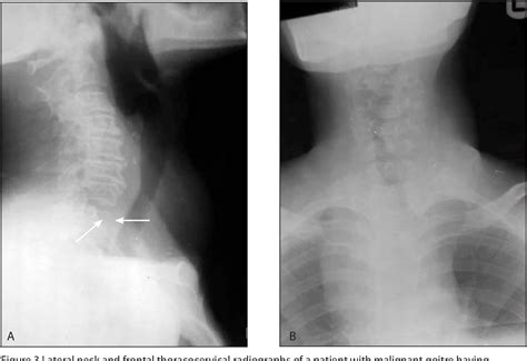 [PDF] Thyroid calcification: radiographic patterns and histological significance | Semantic Scholar