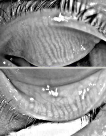 MEIBOMIAN GLAND IMAGING AND EXPRESSION – Dry Eye Equation