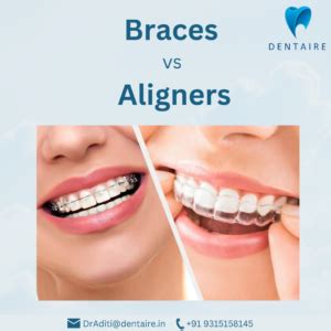 Aligners vs. Braces: Comparing Costs and Benefits