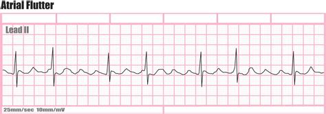 Holter monitor uses, instructions, preparations and Holter monitor results