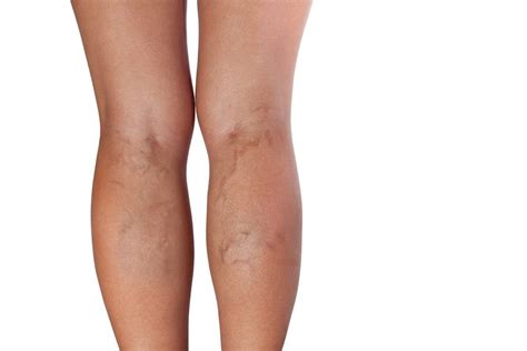 Por Qué Aparecen Las Varices Y Cómo Prevenirlas Belleza Ideal