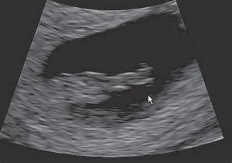 Sirenomelia Ultrasound