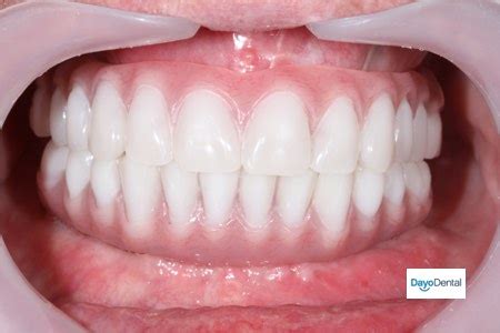 Denture Implants vs Fixed Bridge - Teeth Replacement Options - False teeth