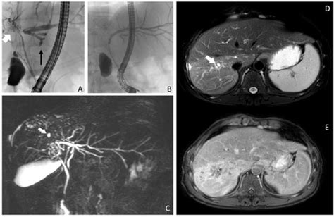 Pathogens Free Full Text Alveolar Echinococcosis In A Patient With Presumed Autoimmune