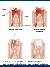 ENDODONCIA GUAYAQUIL METROPOLITAN DENTAL ESPECIALIDADES ODONTOLOGICAS