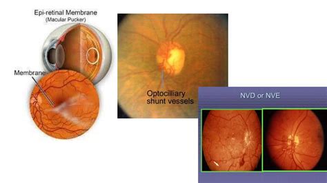 Retinal Vein Occlusion Ppt