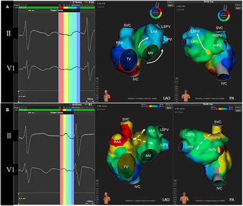 Frontiers Ecg Predictors For New Onset Atrial Fibrillation Within A Year After Radiofrequency