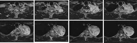 Spinal Schwannoma Radiology Cases