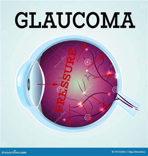 Healthy Eye Glaucoma Stock Vector Illustration Of Ophthalmology 79122006