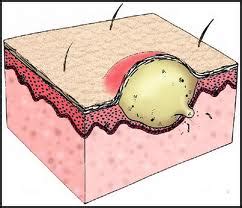 Demodex Folliculorum, what are the symptoms and available treatment for Demodex Folliculorum ...